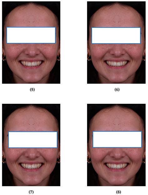 The Role of Dental Natic in Correcting Jaw Misalignment